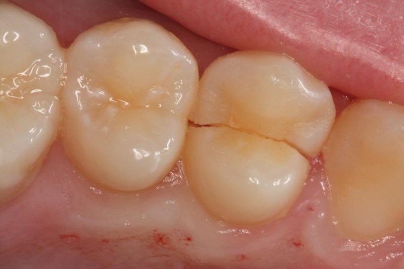 расколотый жевательный зуб